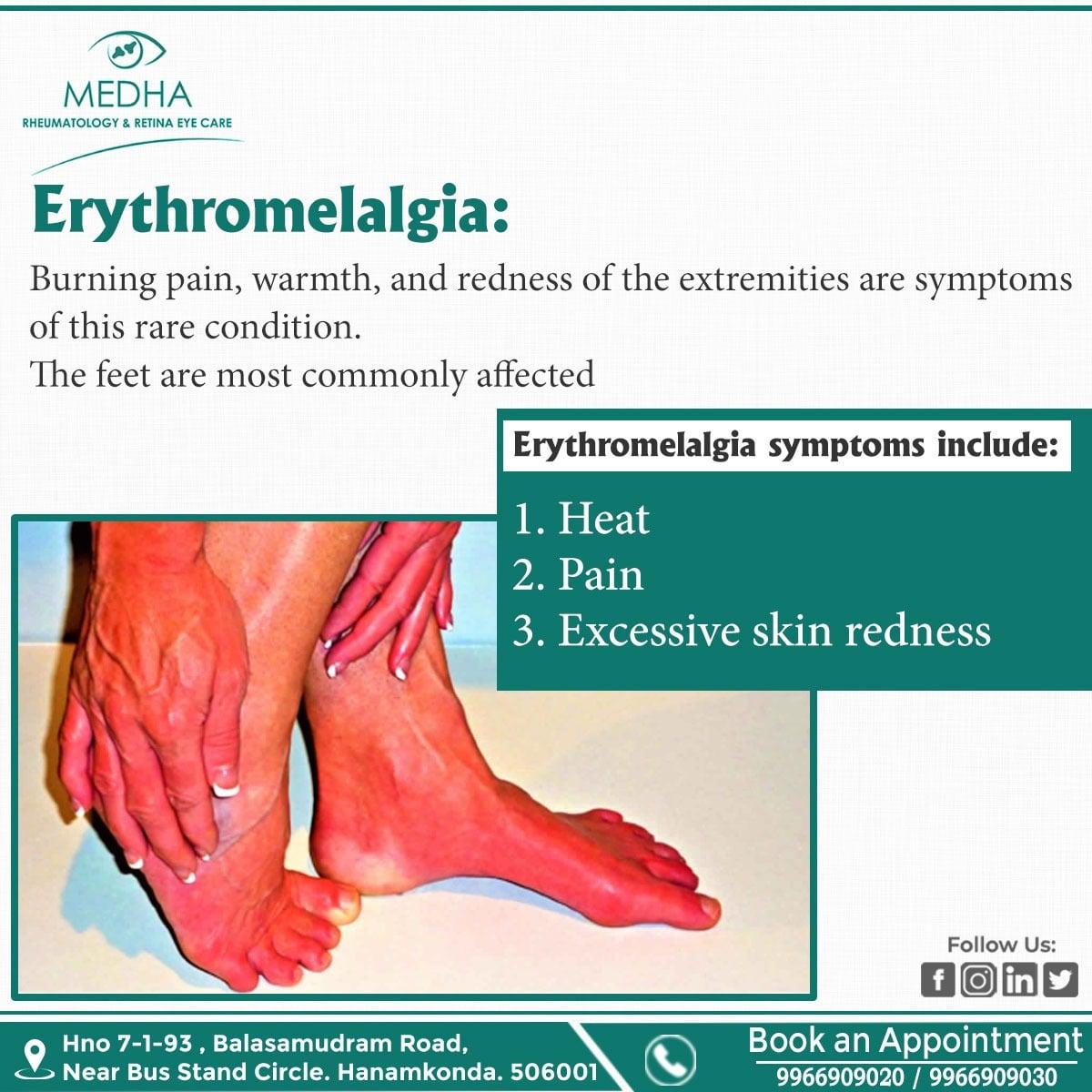 Erythromelalgia (EM)
