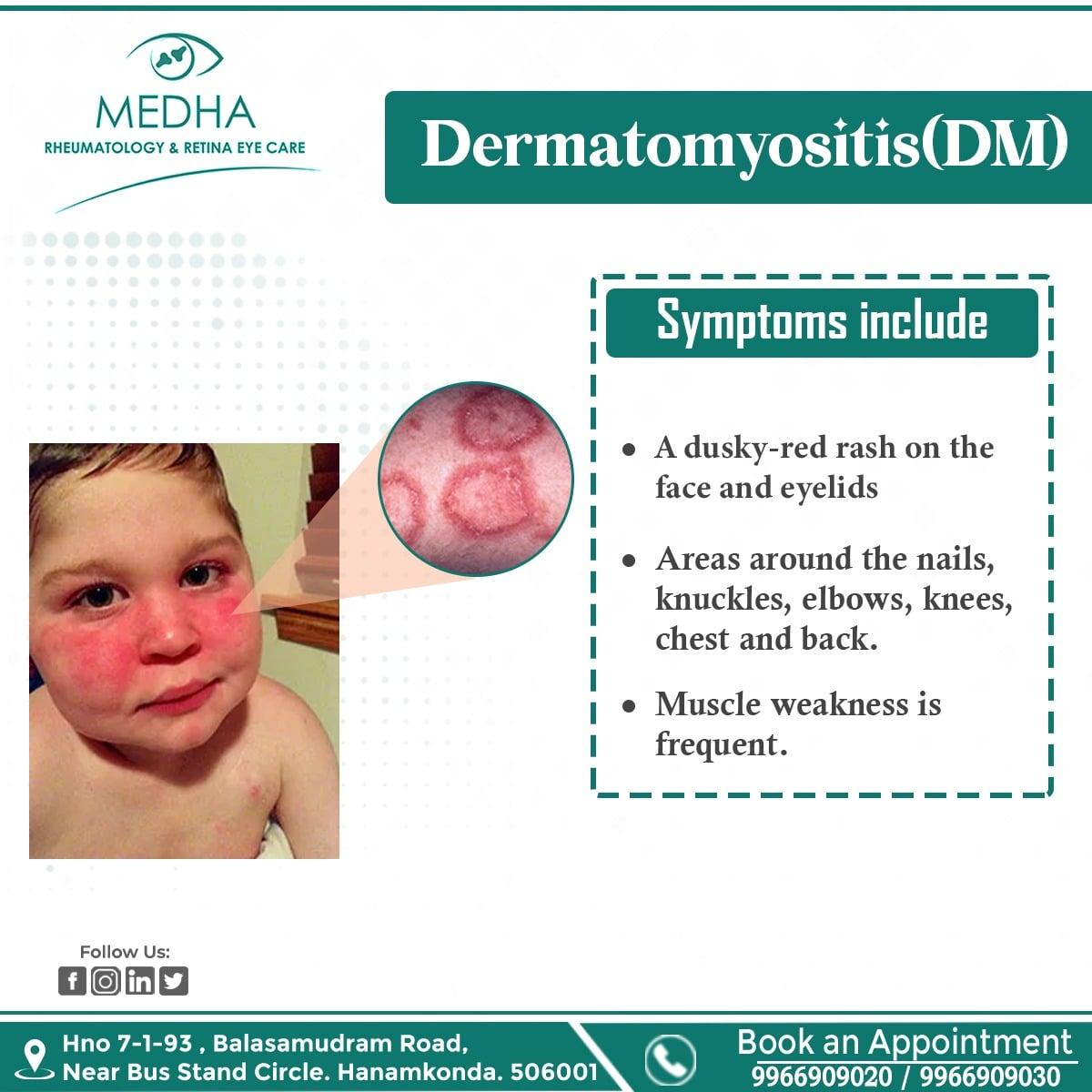 Dermatomyositis (DM)