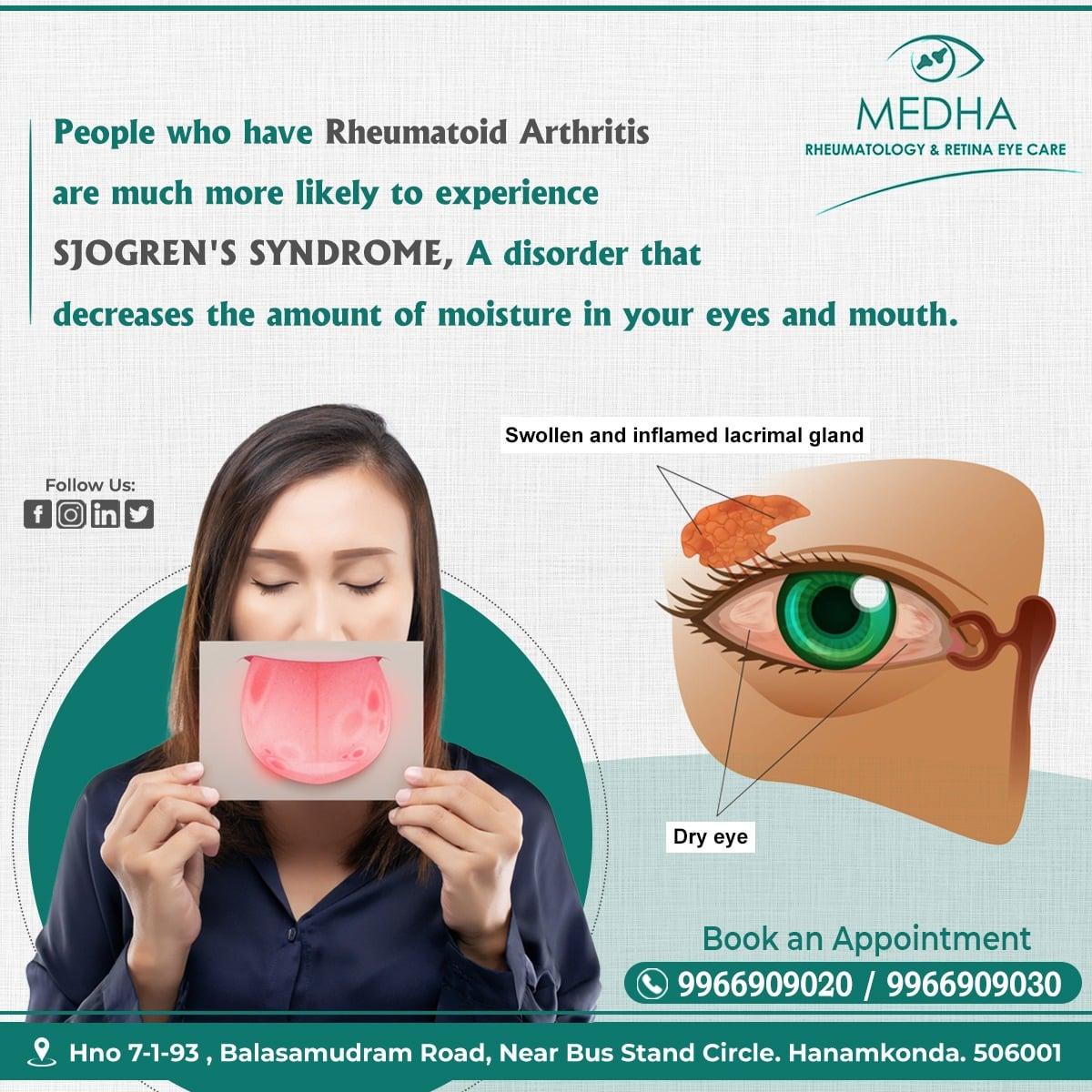 An immune system disorder characterized by dry eyes and dry mouth.