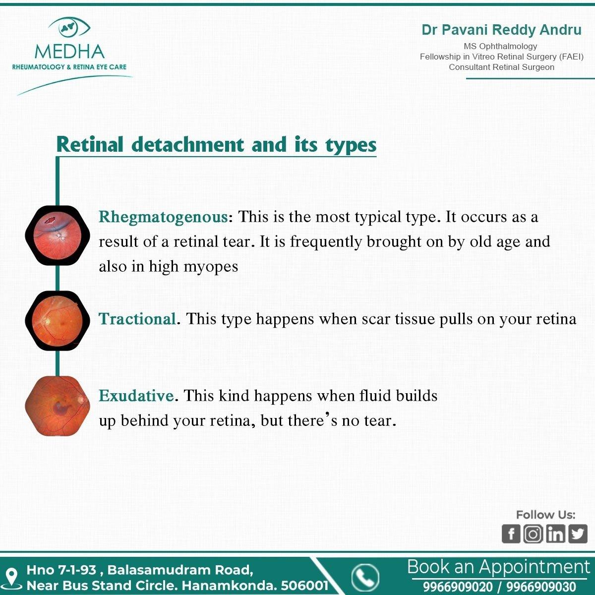 Retinal Detachment types