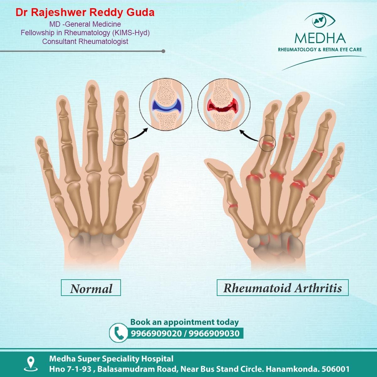 Difference Between Normal Hand & Rheumatoid Arthritis Hand