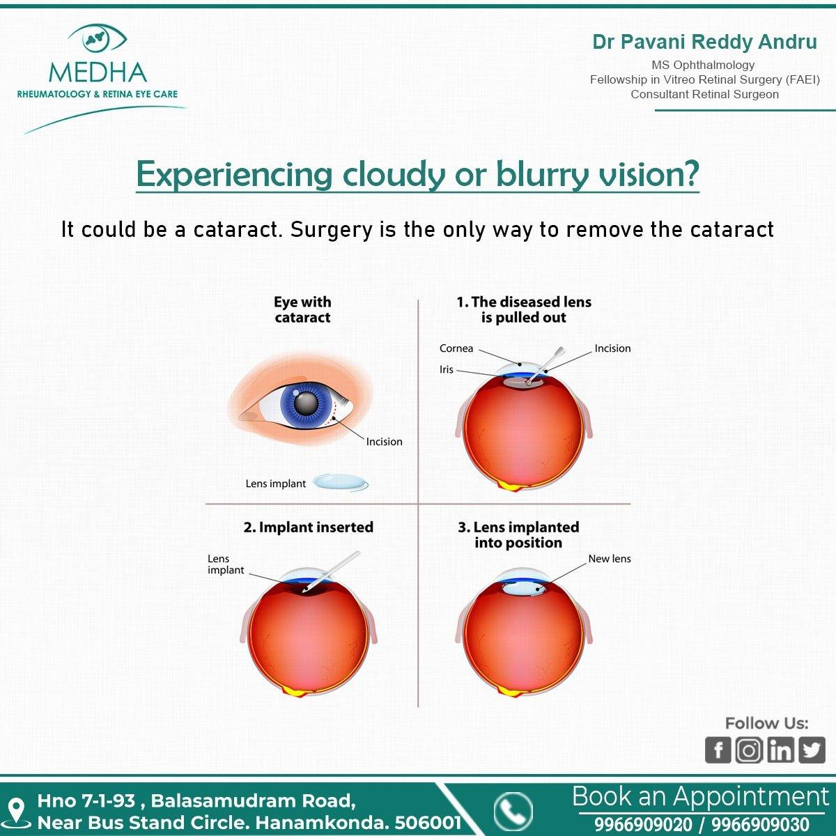 Experiencing Cloudy Or Blurry Vision ?????