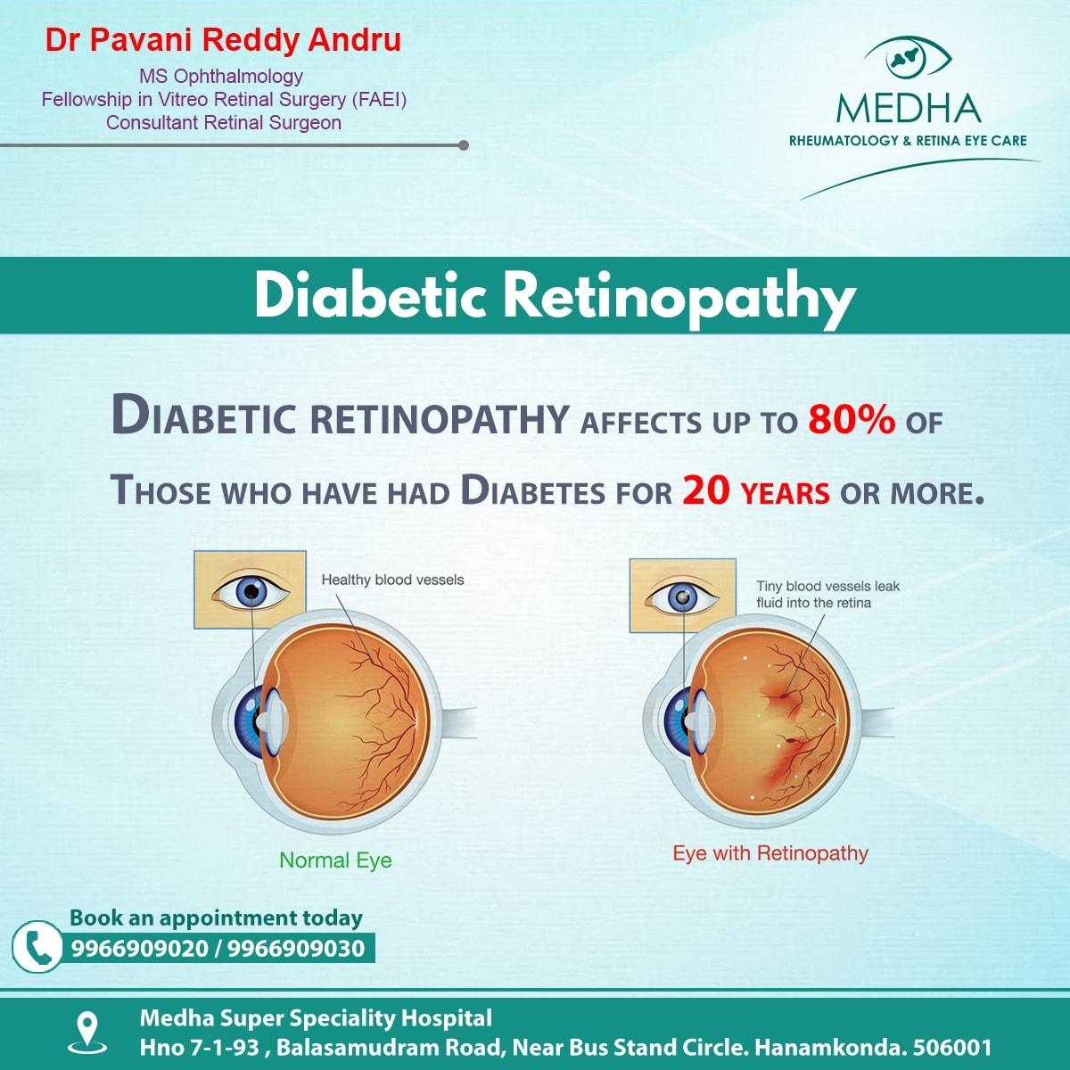 Diabetic Retinopathy Affects more than 80% of Diabetes People