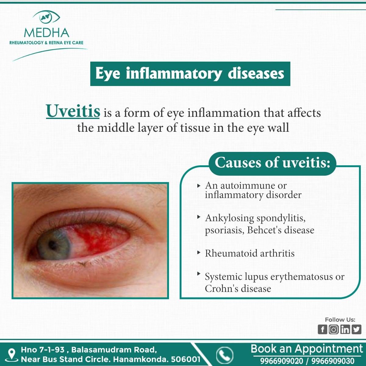 Eye Inflammatory Diseases