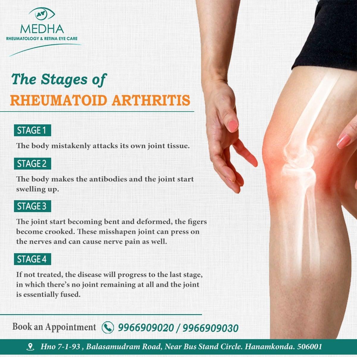 Stages of Rheumatoid Arthritis