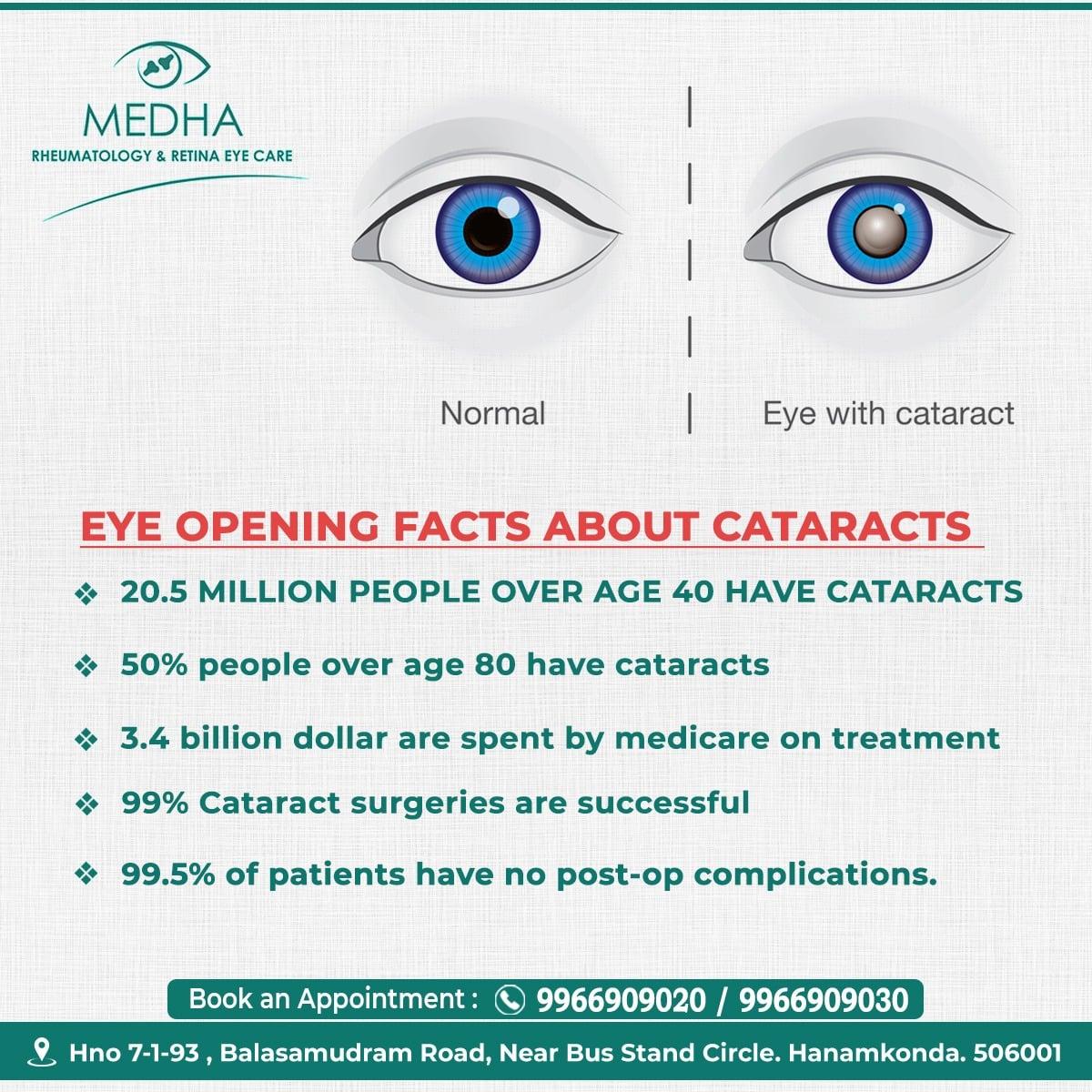 Few FACTS about Cataracts you should know ....