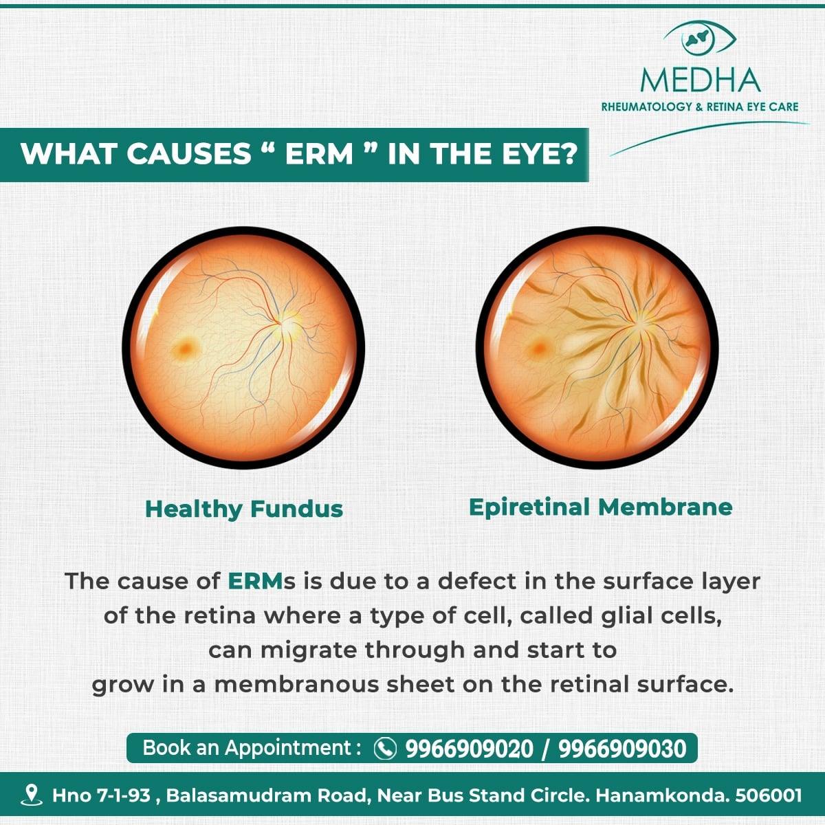 What Causes Epiretinal membranes (ERMs)
