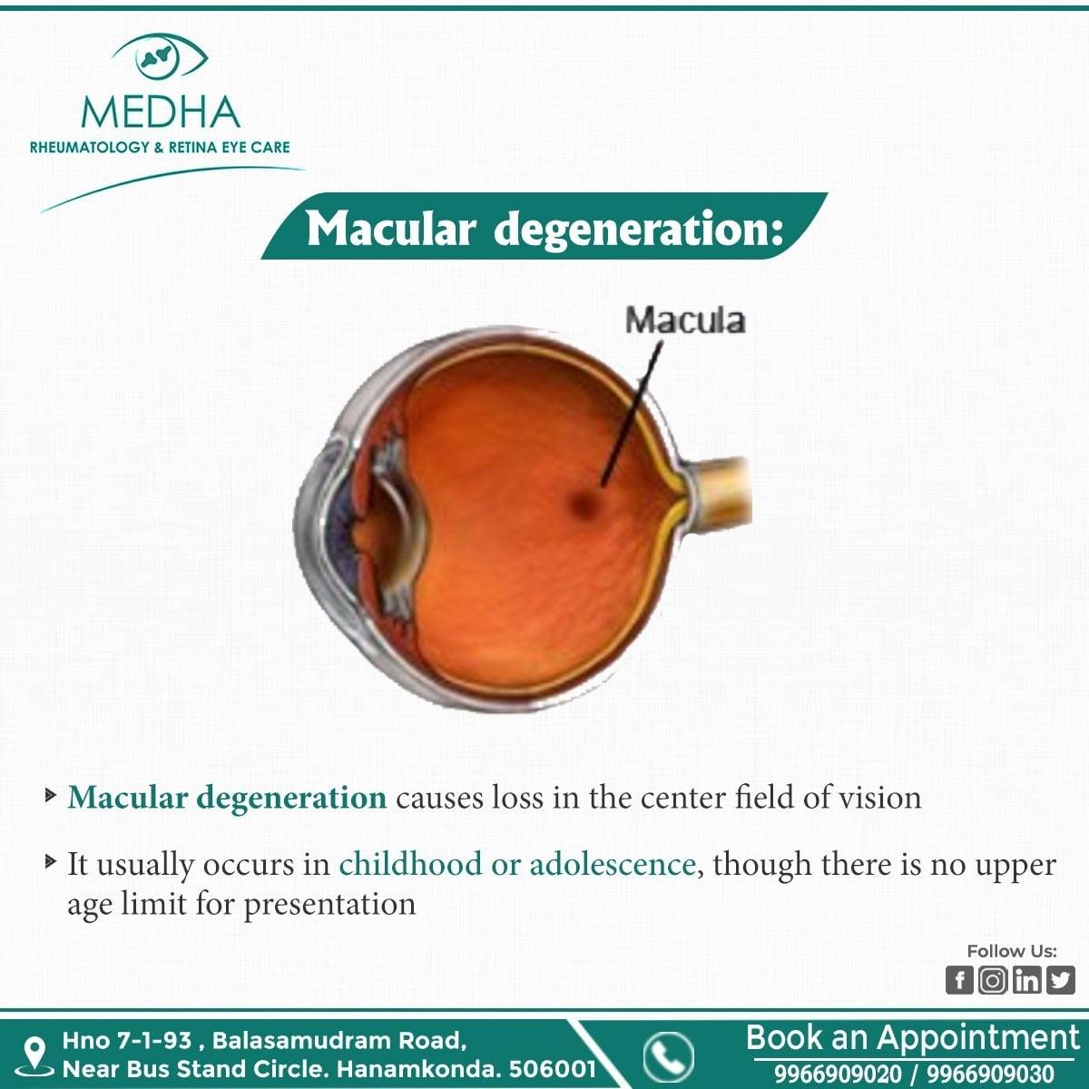 Macular Degeneration Treatment 
