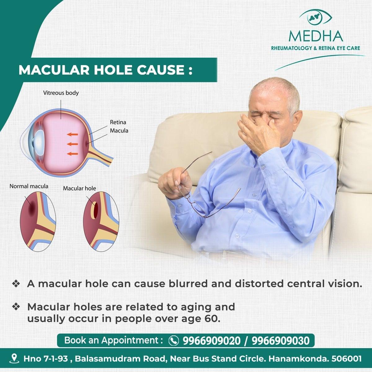 Macular Hole And It's Symptoms And Causes