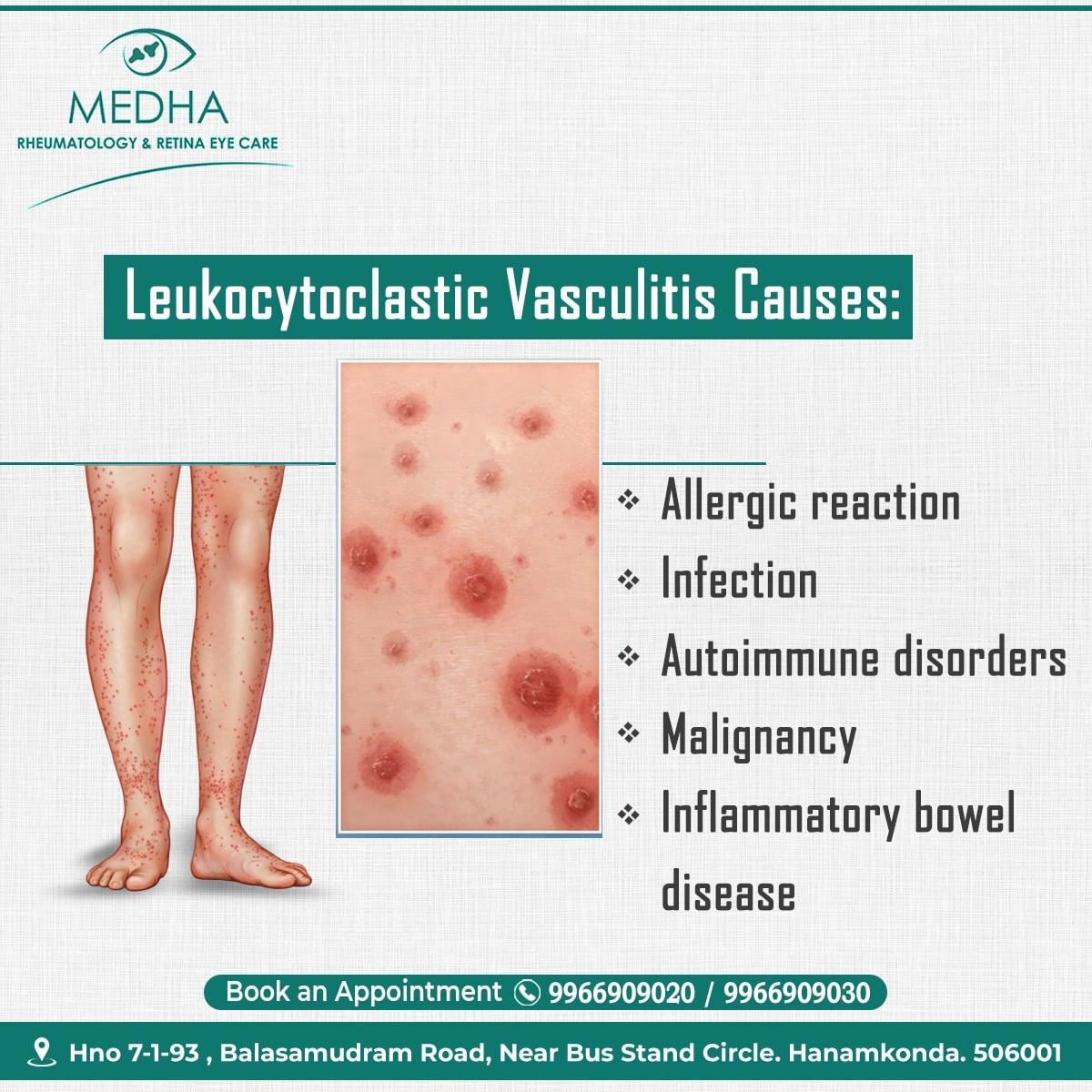 Leukocytoclastic Vasculitis Causes.....