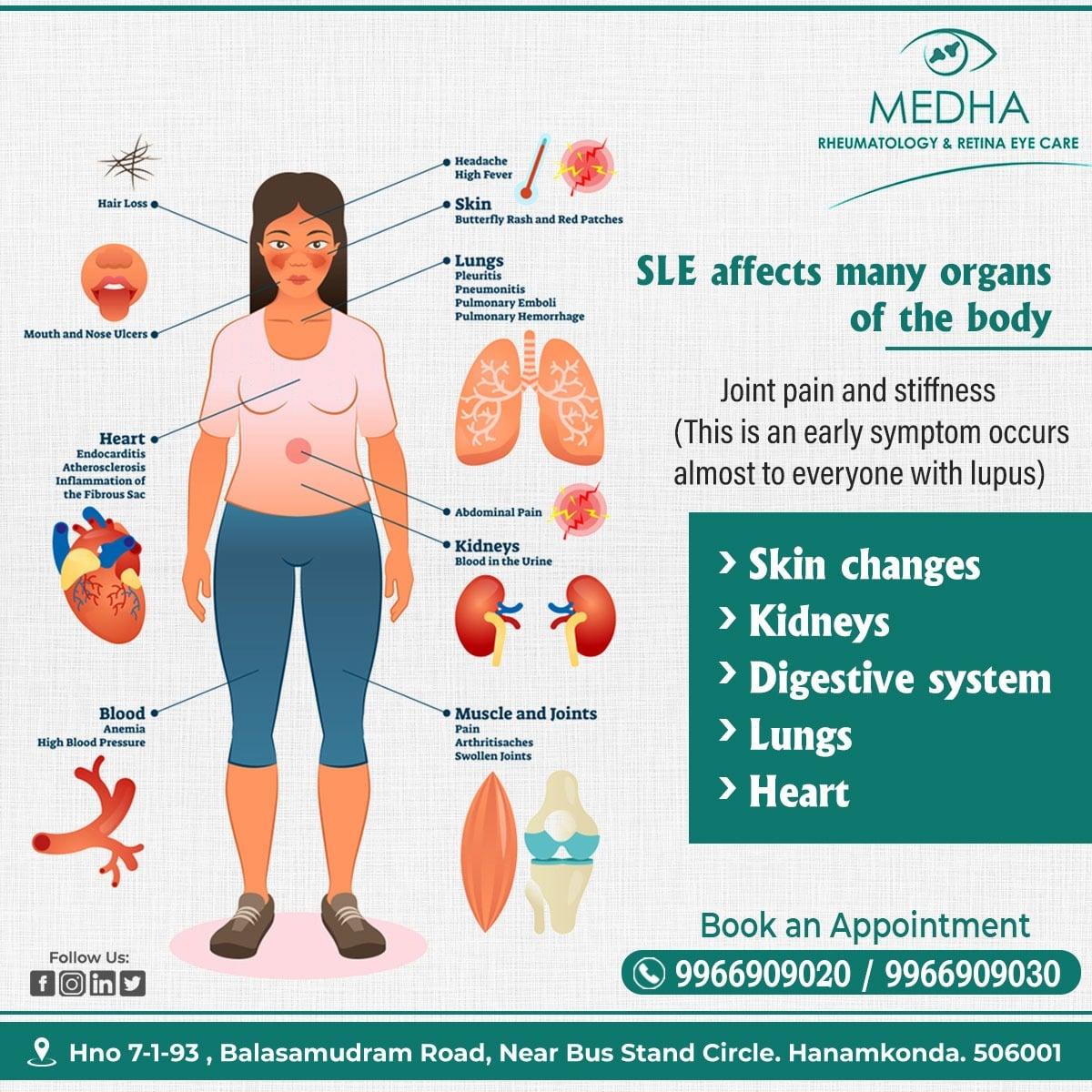 SLE and its affects.....
