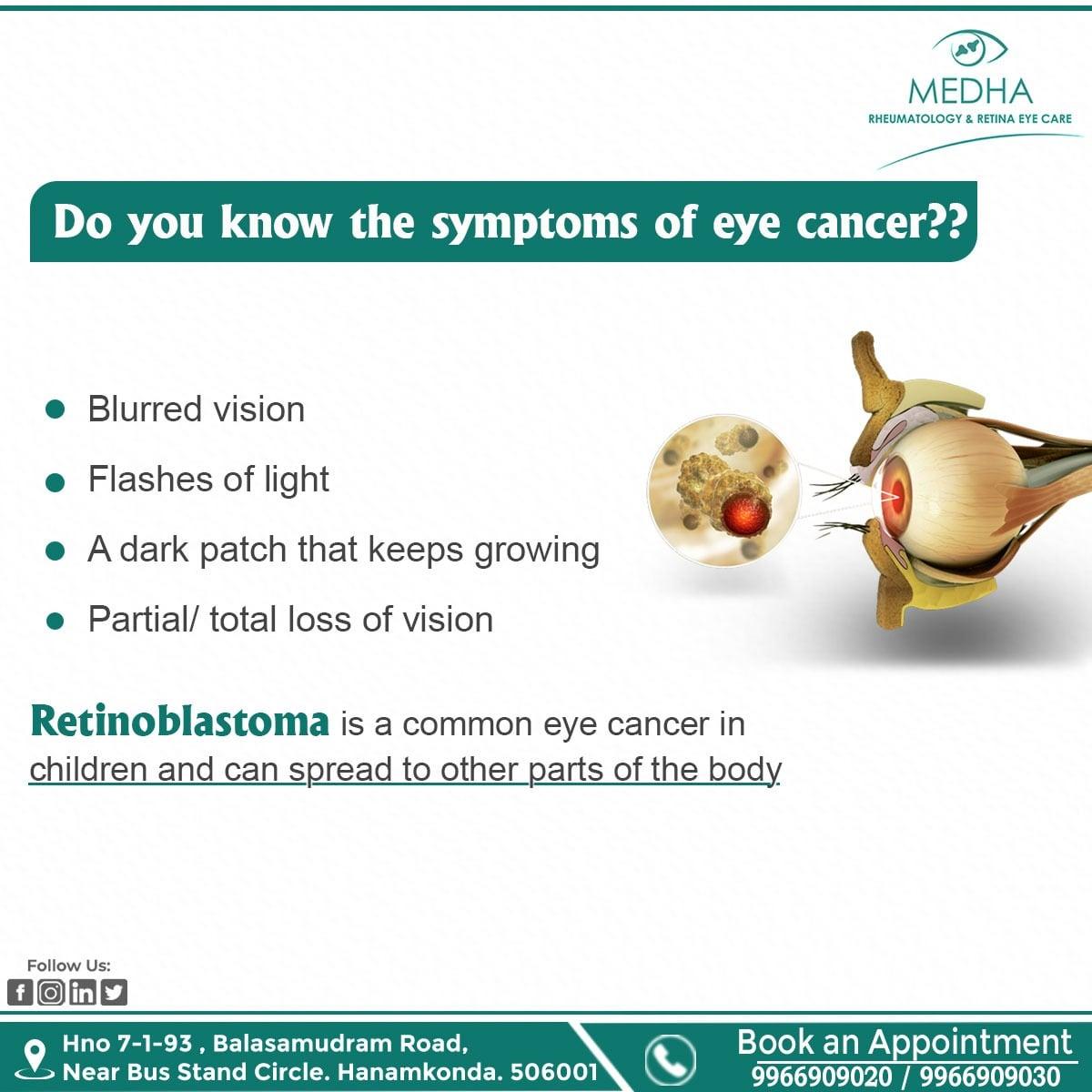 Know About The Symptoms Of Eye Cancer !!!!!!