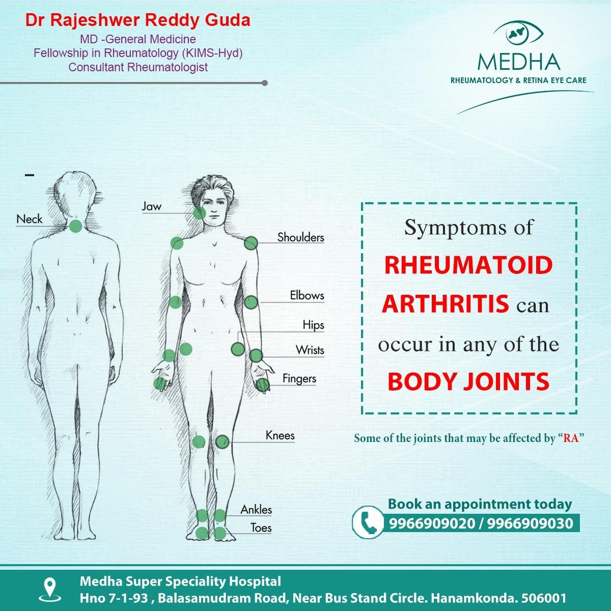 Symptoms of RHEUMATOID ARTHRITIS can occur in any part of the BODY JOINTS