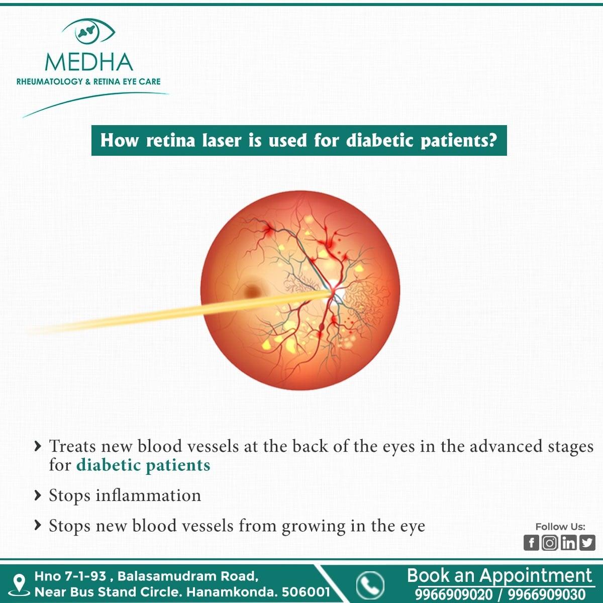How Retina Laser Is Used For Diabetic Patient's 