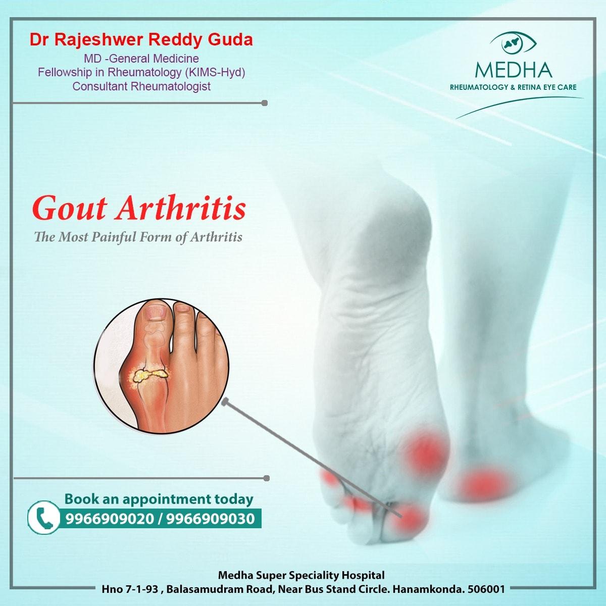Gout Treatment, Signs & Symptoms