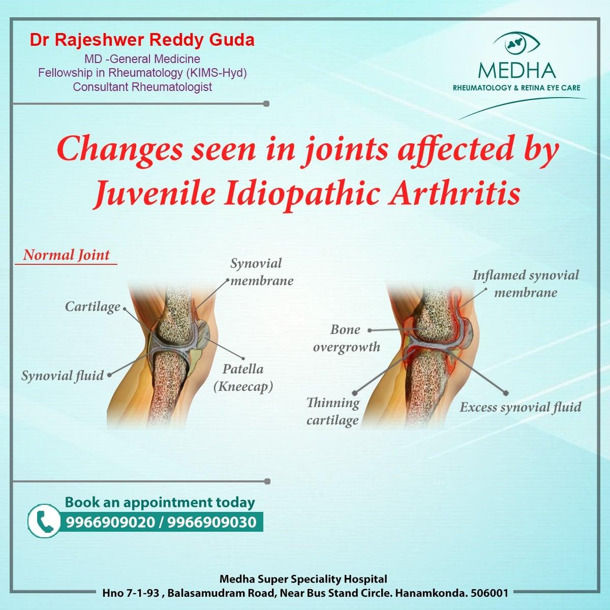 Changes seen in JOINTS affected by JIA