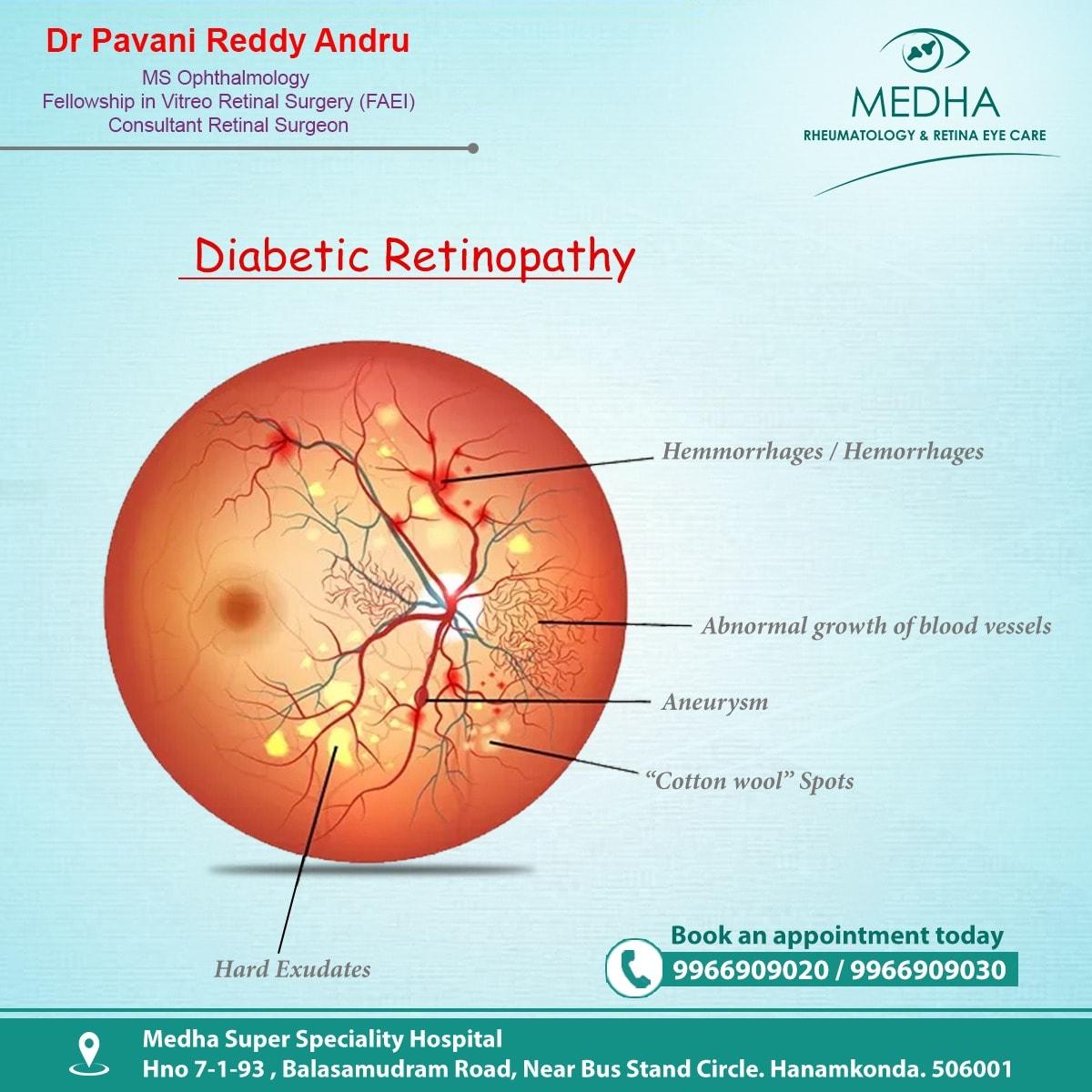 Diabetic Retinopathy and it causes