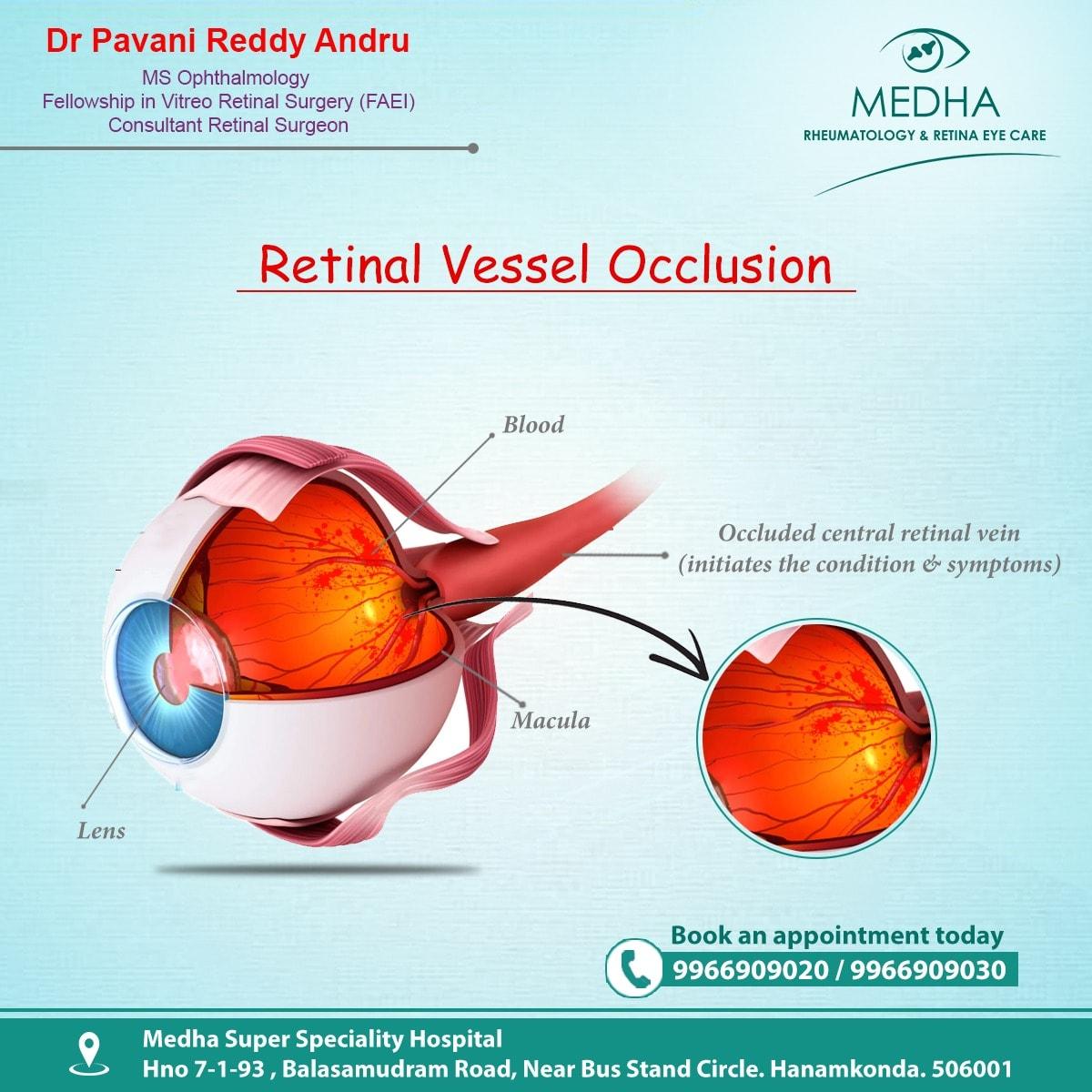 Retinal Vessel Occlusion
